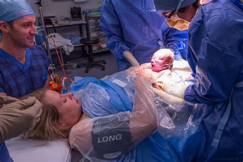 Maternal Assisted Caesarean Sections Exxpectations