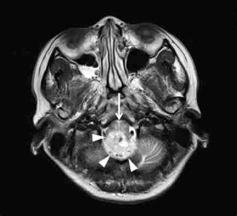 Preoperative T2 Weighted Mri Scans Showing A Large Tumor White Download Scientific Diagram