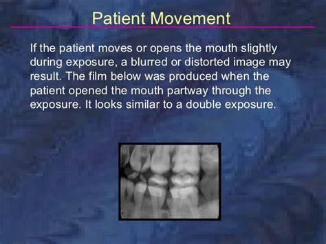 radiology-bitewing-technique