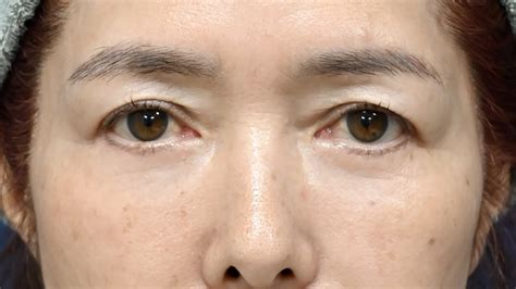 表ハムラ法（62歳女性）｜症例写真｜あじまビューティークリニック【公式】