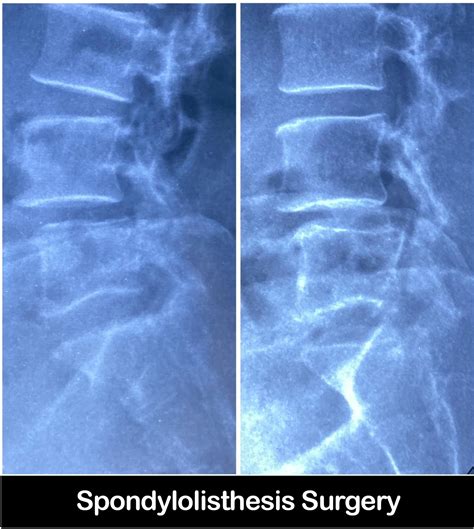 Best Spondylolisthesis Surgery in Faridabad