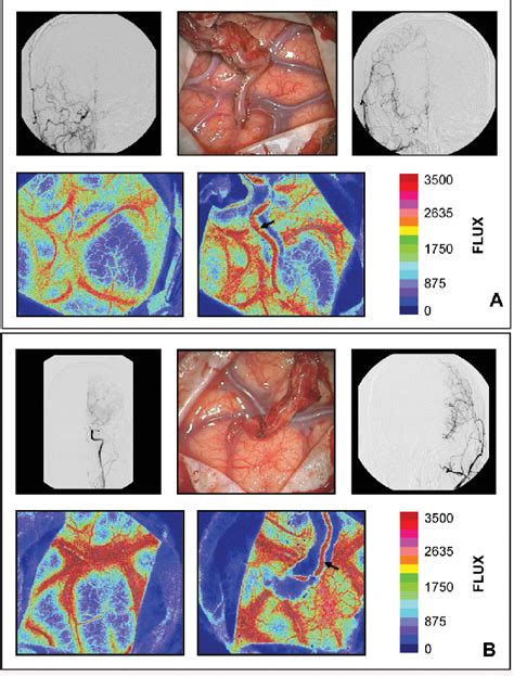 Figure 1 From Intraoperative Monitoring Of Cerebral Blood Flow By Laser