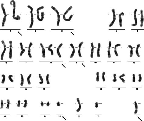 Karyotype Of A Gtg Banded Metaphase Revealing Complex Chromosome