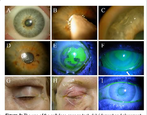 Figure 3 From Self Retained Amniotic Membrane For Recurrent Corneal