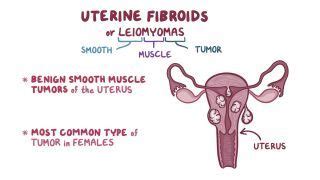 Leiomyoma of Uterus (Uterine Fibroid): What Is It, Causes, Types ...