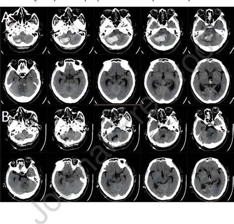 Table 1 From Surgical Evacuation Of Spontaneous Cerebellar Hemorrhage