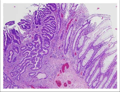 Invasive Colonic Adenocarcinoma On The Left And Normal Colonic Mucosa Download Scientific