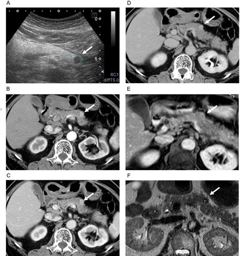 Figure From Efficacy Of Perioperative Endoscopic Naso Pancreatic