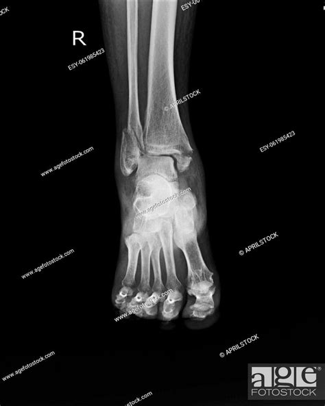 X Ray Right Ankle A Woman Year Ole Accident Showing Spiral Fracture