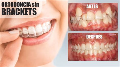 ORTODONCIA SIN BRACKETS DIGITAL O INVISIBLE INVISALIGN SANTIAGO