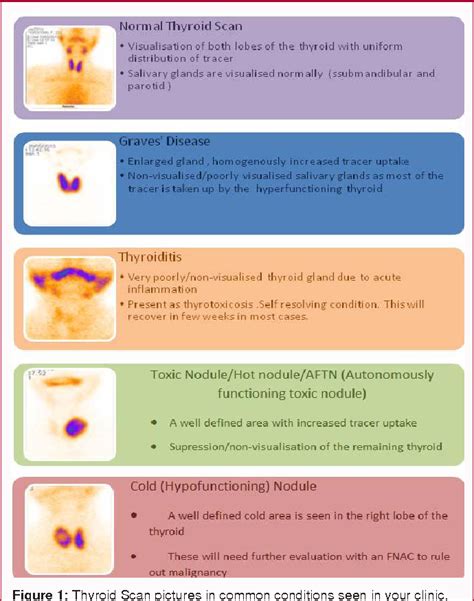 Nuclear Scanning In Evaluation And Treatment Of Thyroid Disorders A