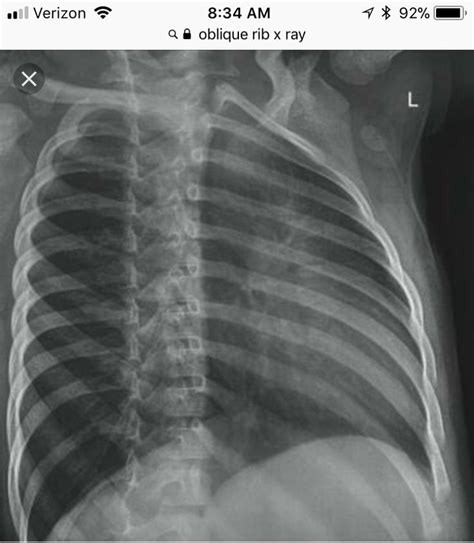 Oblique Ribs- used to visualize anteriolateral/ posteriolateral | Radiology student, Radiology ...