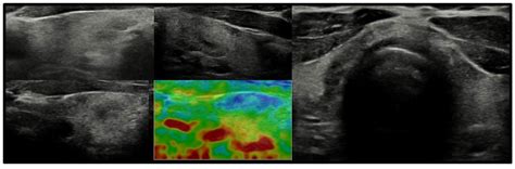 Frontiers New Insights Into Thyroid Dysfunction In Patients With Inactivating Parathyroid