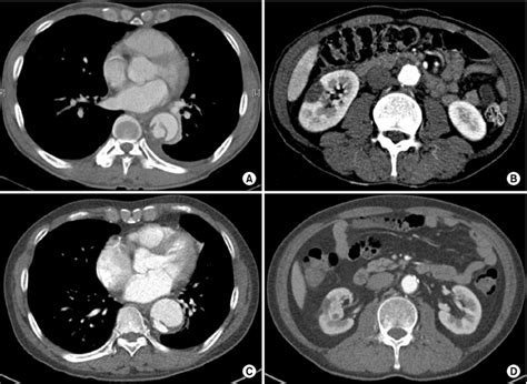 A Initial Preoperative Computed Tomography Ct Scan Showing An Acute