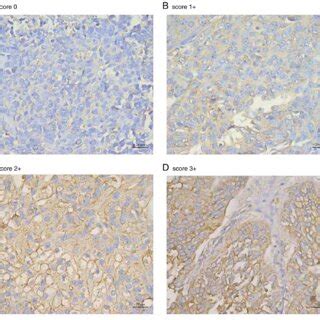 Immunohistochemical Staining Of Urothelial Carcinoma Of The Bladder