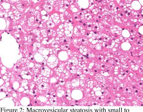 Fatty Liver Histology