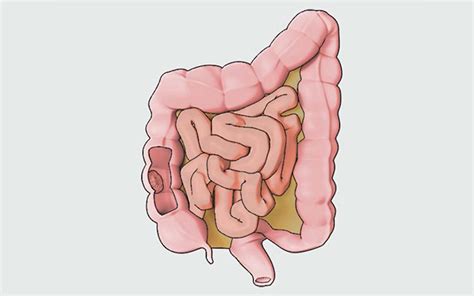 Patient Learning Low Anterior Resection Tvasurg The Toronto Video