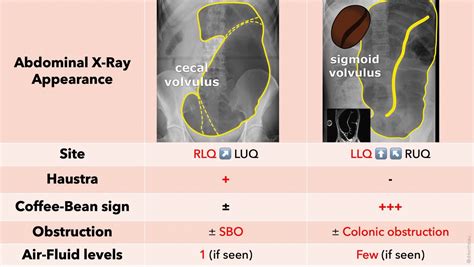 Keith Siau On Twitter The Incredible Scenes Of A Sigmoid Volvulus