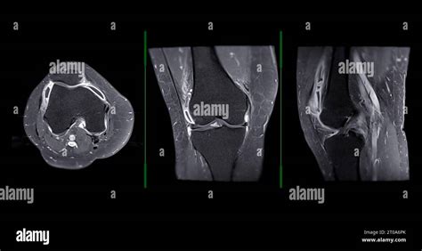 Magnetic Resonance Imaging Or Mri Of Knee Joint C For Detect Tear Or