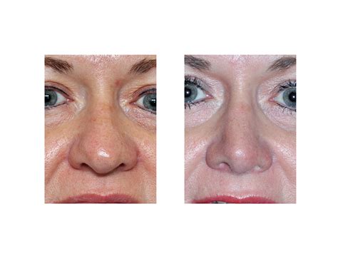 Case Study: Rhinoplasty for the 'Fat' Nose - Explore Plastic Surgery