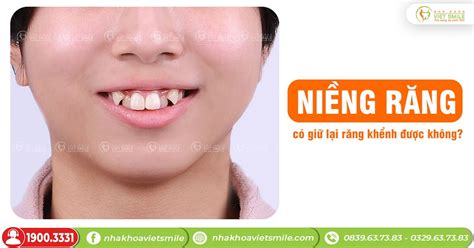 Niềng răng có giữ lại răng khểnh được không