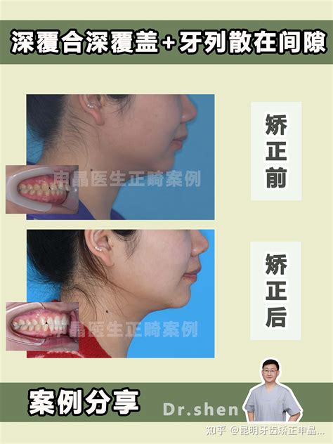 昆明牙齿矫正昆明正畸不拔牙矫正深覆合深覆盖牙齿散在间隙 知乎