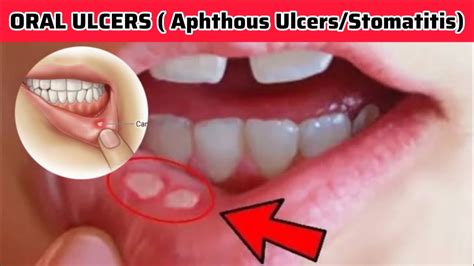 Oral Ulcers Aphthous Ulcers Stomatitis Sign Symptoms And Treatment