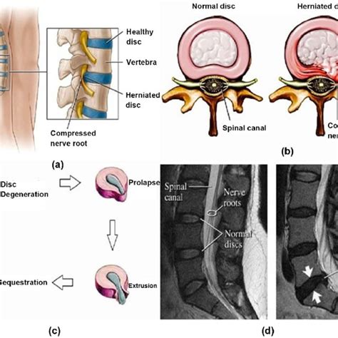 Lumbar Disc Herniation A Showing Herniated Disc At L4l5 Level 14