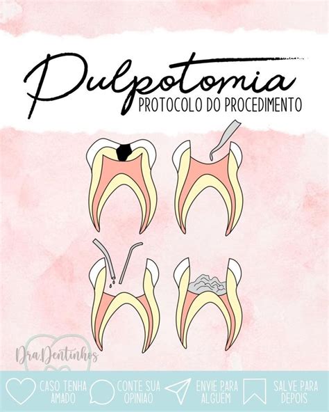 dra dentinhos alice on Instagram PULPOTOMIA REMOÇÃO DA POLPA