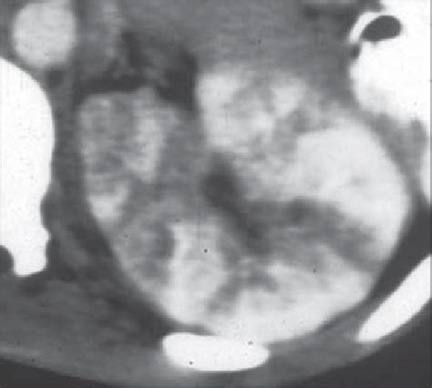 Spotted nephrogram in 13-year-old boy. Normally homogeneous nephrogram... | Download Scientific ...