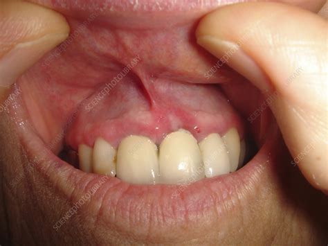 Mucous Membrane Pemphigoid Oral