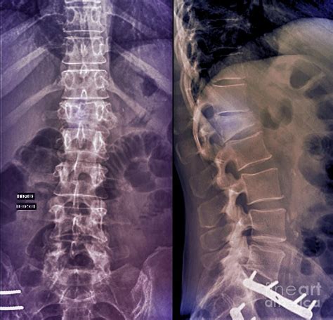 Lumbar Fracture Types