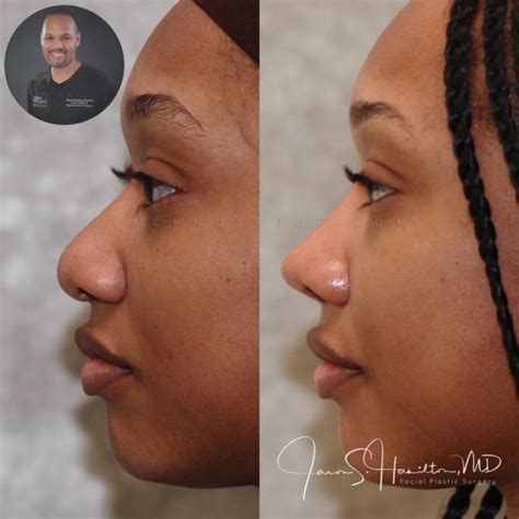 African American Rhinoplasty Los Angeles Black Nose Surgery