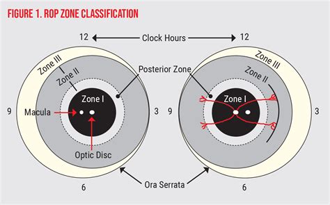 Classifying Retinopathy Of Prematurity