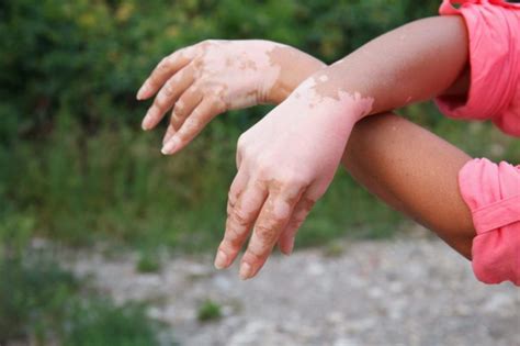 Can Ruxolitinib reverse Vitiligo? - Unite For Vitiligo