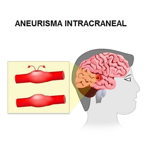 Aneurisma Qu Es S Ntomas Tipos Causas Tratamiento Y Mucho M S