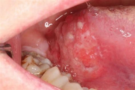 Oral Cavity Cancer Causes Symptoms Diagnosis Treatment Prognosis