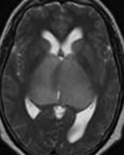 Bilateral Thalamic Lesions Ajr