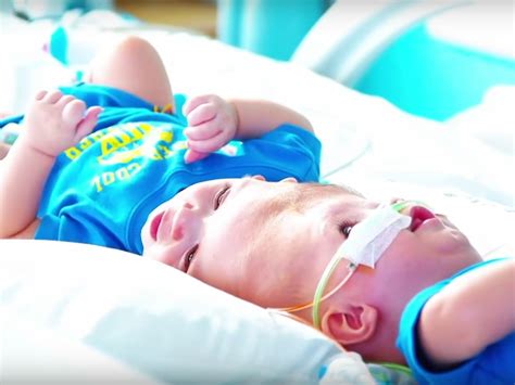 Conjoined Twins To Be Separated In Rare Surgery Inverse