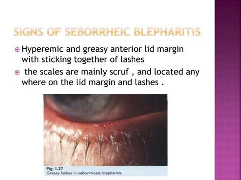 Seborrheic Vs Staph Blepharitis