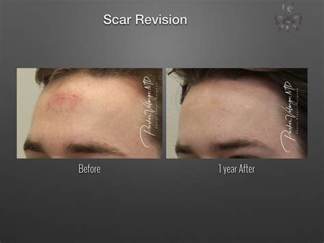 Scar Revision | Keloid Treatment | New Orleans Center for Aesthetics ...