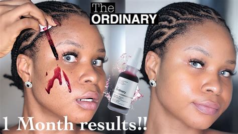 The Ordinary Aha 30 Bha 2 Peeling Solution 1 Month Real Results Honest Review Youtube