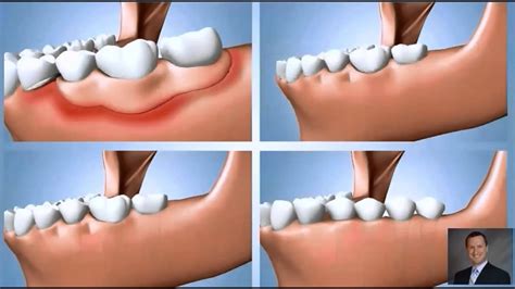 Several Missing Teeth Summary Dr Nugent Youtube