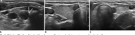 Figure 3 From Sonographic Assessment Of The Extent Of Extrathyroidal Extension In Thyroid Cancer