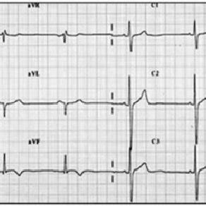 Left posterior fascicular block. | Download Scientific Diagram