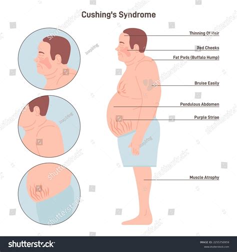 Cushing Syndrome What Is It Causes Treatment And More 58 Off