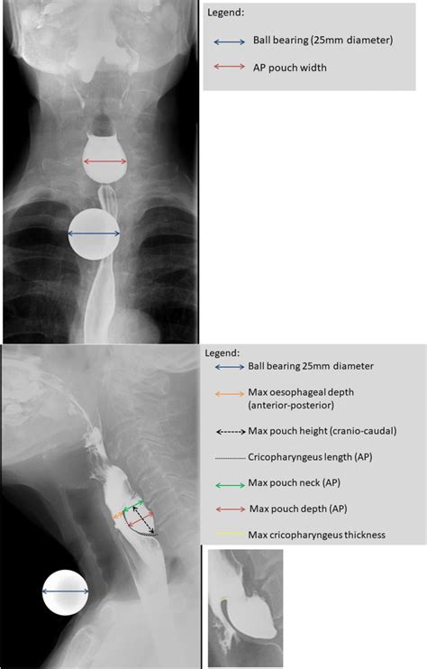 Protocol For The Measurement Of Zenker’s Diverticulum On Barium Download Scientific Diagram