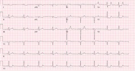 Figure Isolated Posterior Myocardial Infarction Cath