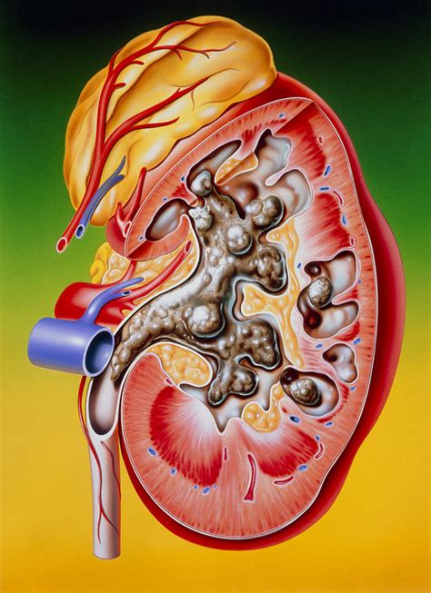 Illustration Of A Calculus Or Stone In The Kidney Photograph By John Bavosi