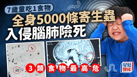 7歲童吃1種食物 全身佈滿5000條寄生蟲 入侵腦肺險死 3種食物風險高